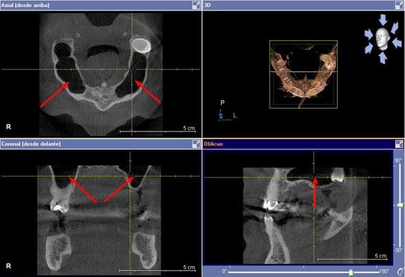 TAC-escaner-dental-barato-implantes-dentales-3