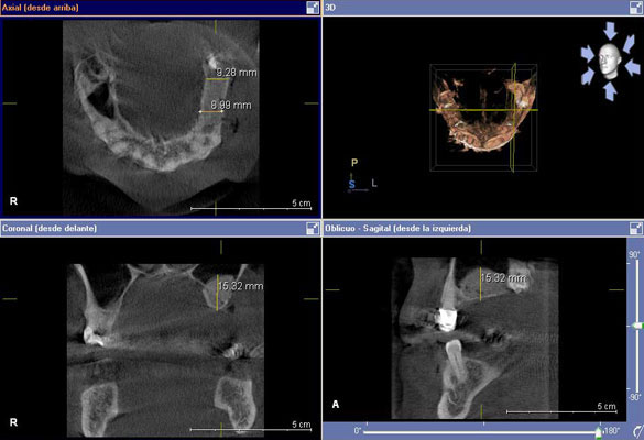 TAC-escaner-dental-barato-implantes-dentales-4