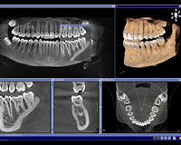 TAC-escaner-dental-clinica-velazquez-madrid