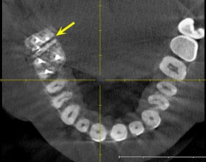 TAC-escaner-dental-endodoncias-4