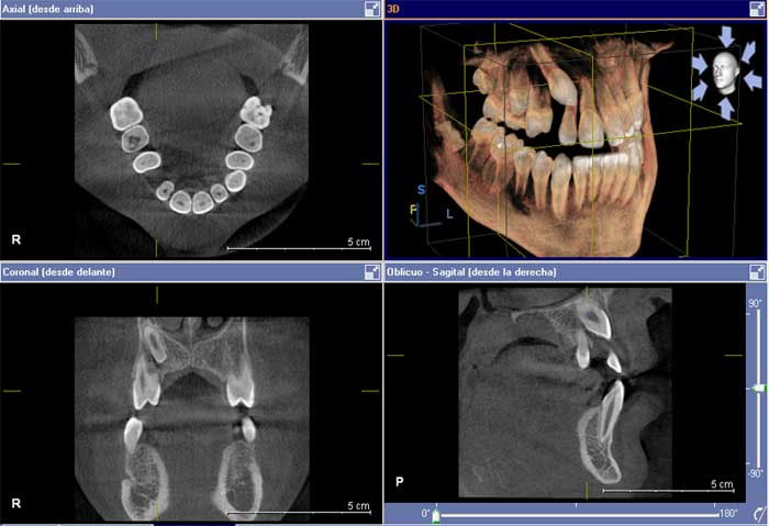 TAC-escaner-dental-ortodoncia-canino-incluido