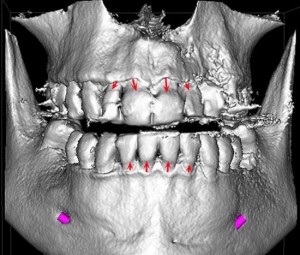 TAC-escaner-dental-periodoncia-1